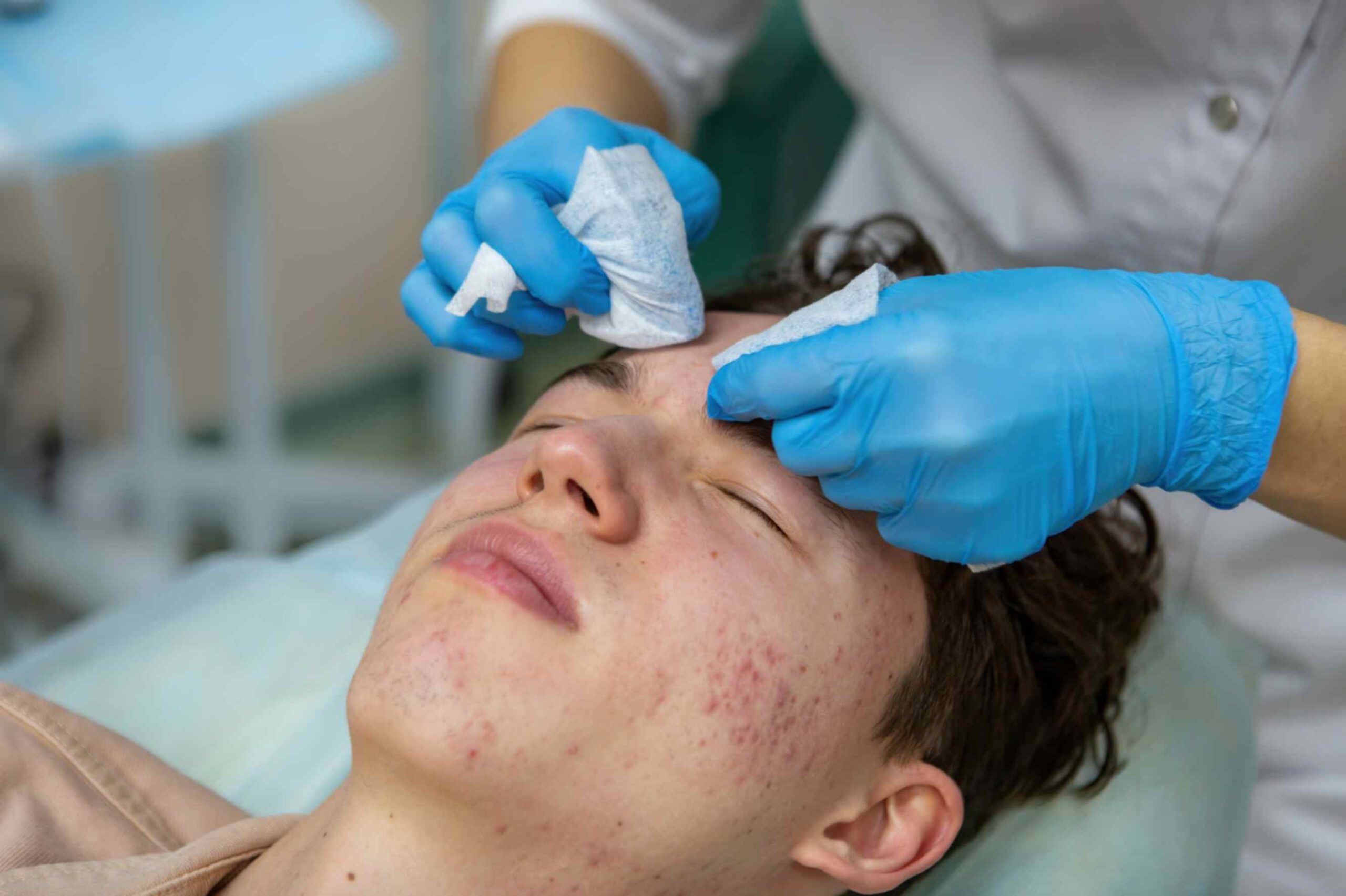 Acne Vulgaris Treatment