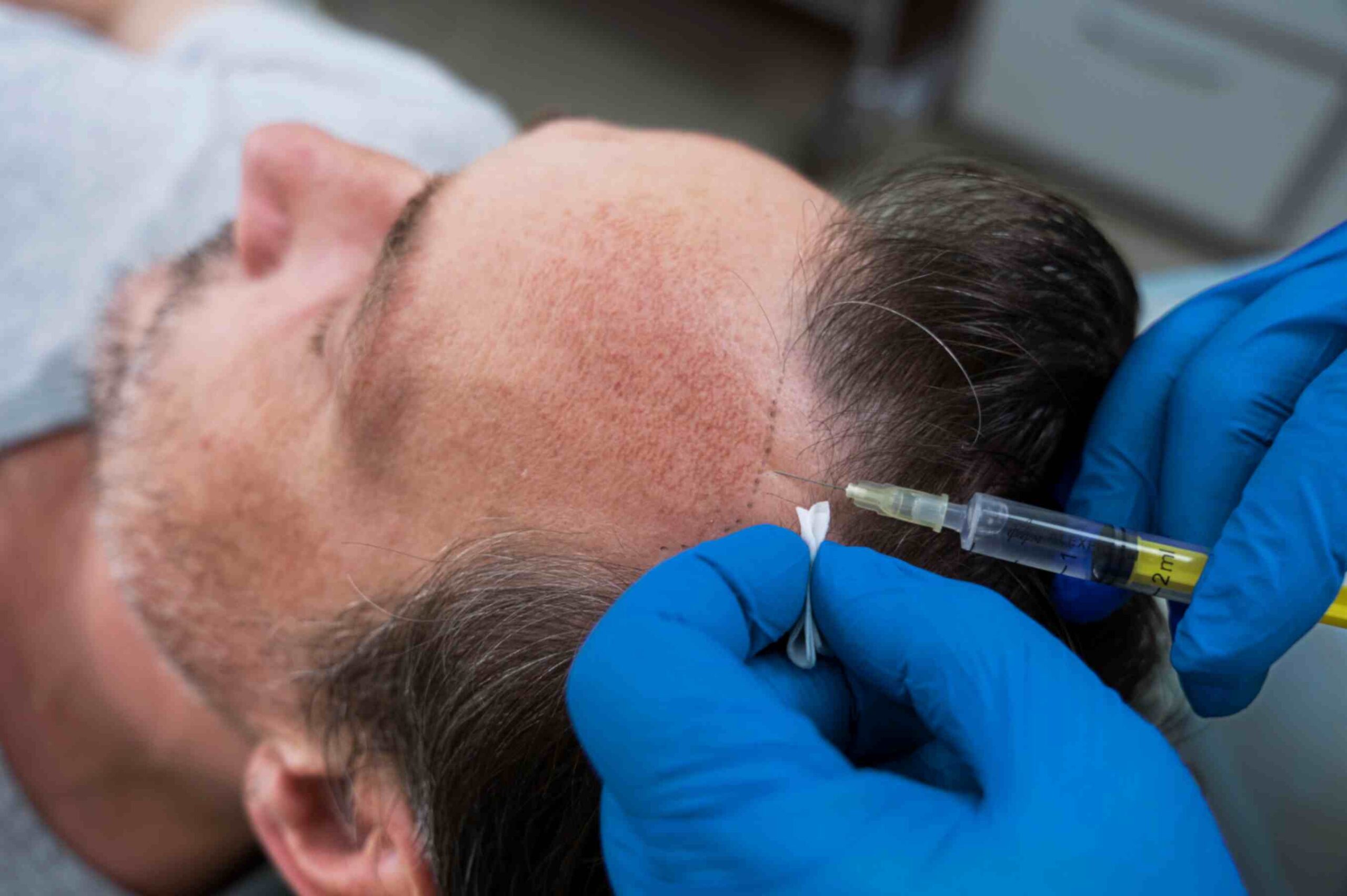Hair-PRP-Therapy-2-scaled