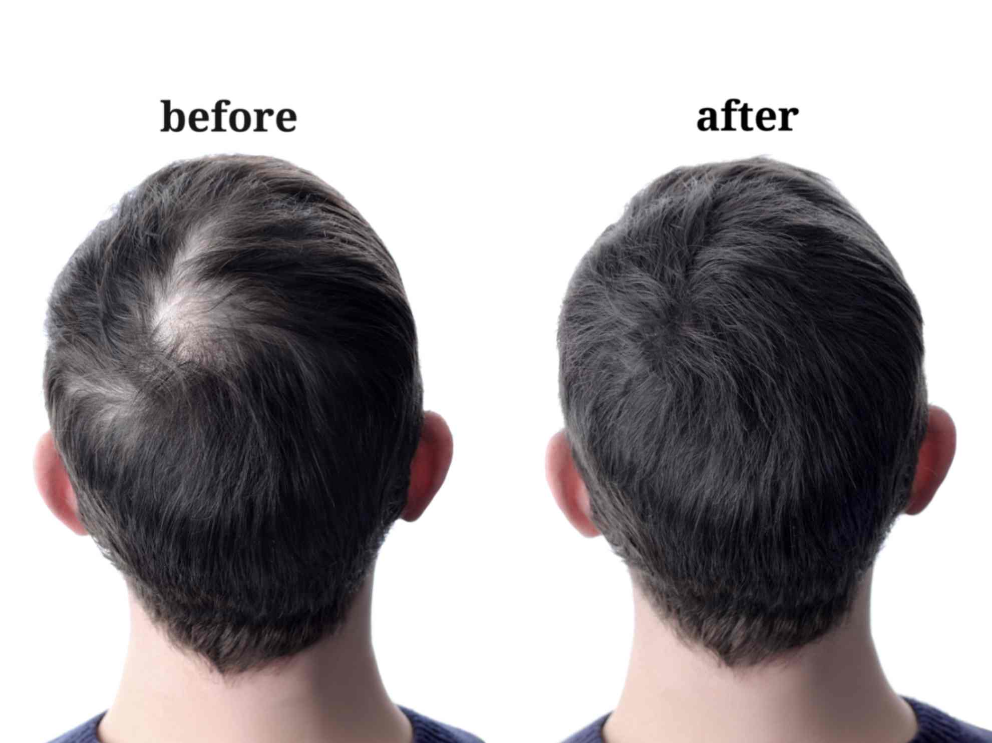 Male-Pattern-Baldness-Treatment