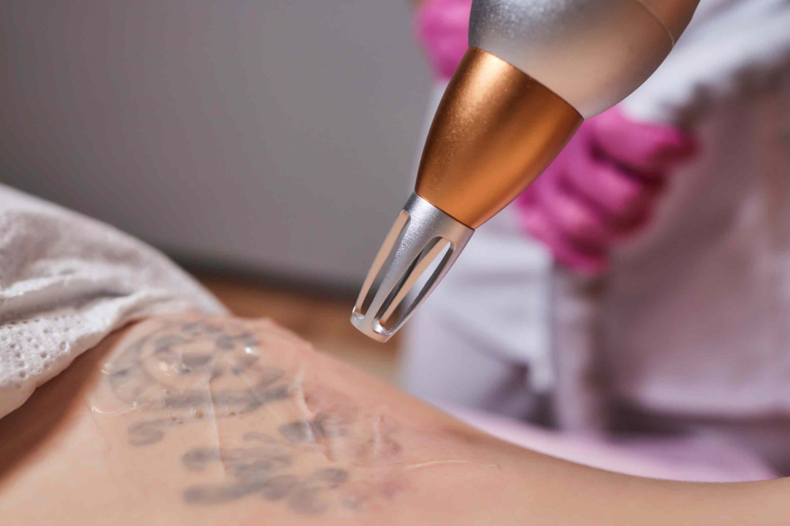 Tattoo Removal